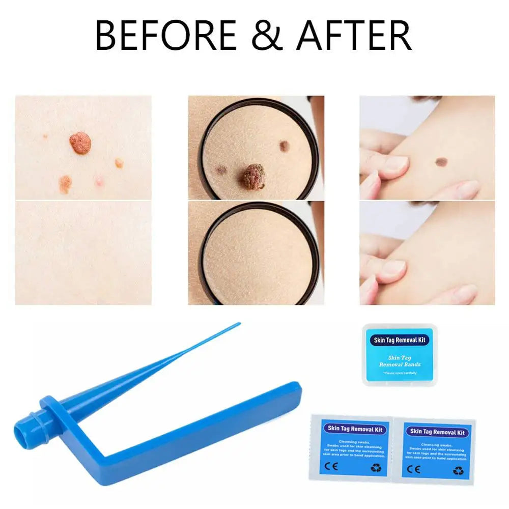 Micro skin tag remover remover patch Mole remover Kit Remove Acne Pimple Treatments Cleansing Swabs  Face Skin Care Beauty