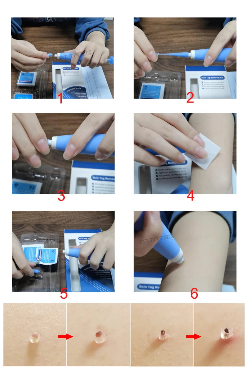 Micro skin tag remover remover patch Mole remover Kit Remove Acne Pimple Treatments Cleansing Swabs  Face Skin Care Beauty
