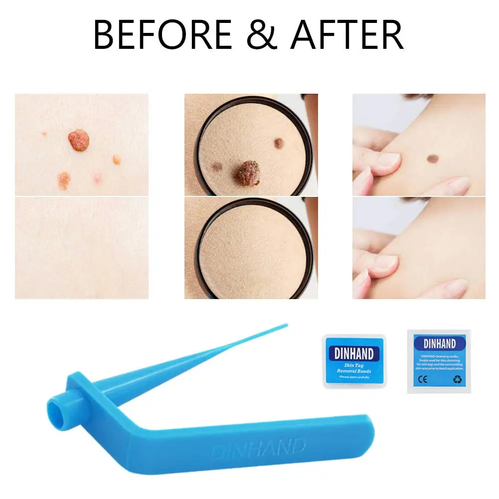 Micro skin tag remover remover patch Mole remover Kit Remove Acne Pimple Treatments Cleansing Swabs  Face Skin Care Beauty