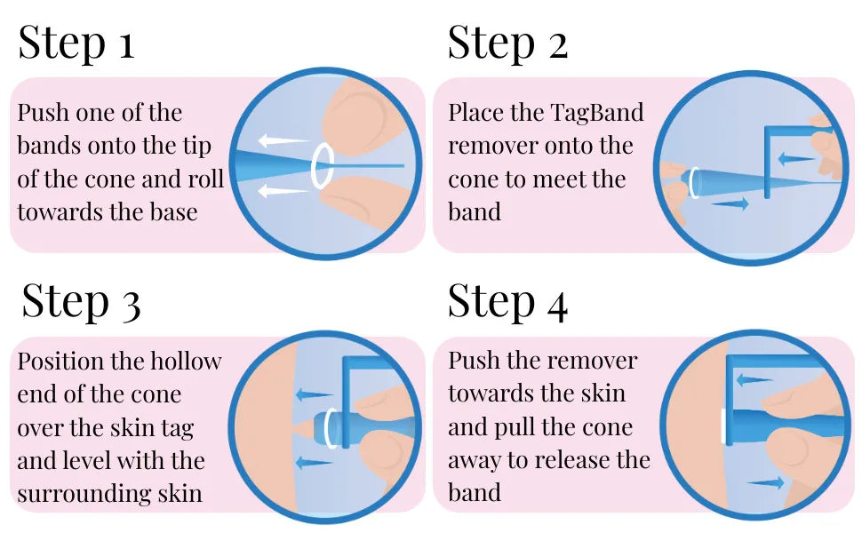 Micro skin tag remover remover patch Mole remover Kit Remove Acne Pimple Treatments Cleansing Swabs  Face Skin Care Beauty