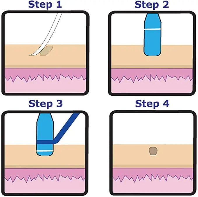Micro skin tag remover remover patch Mole remover Kit Remove Acne Pimple Treatments Cleansing Swabs  Face Skin Care Beauty