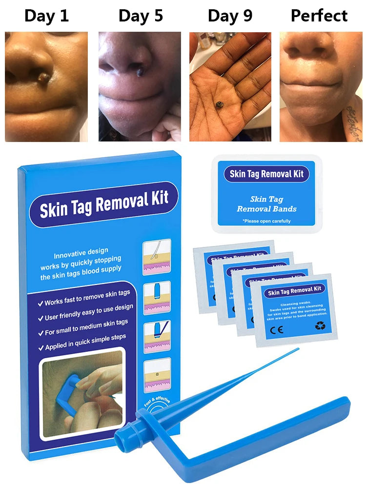 Micro skin tag remover remover patch Mole remover Kit Remove Acne Pimple Treatments Cleansing Swabs  Face Skin Care Beauty