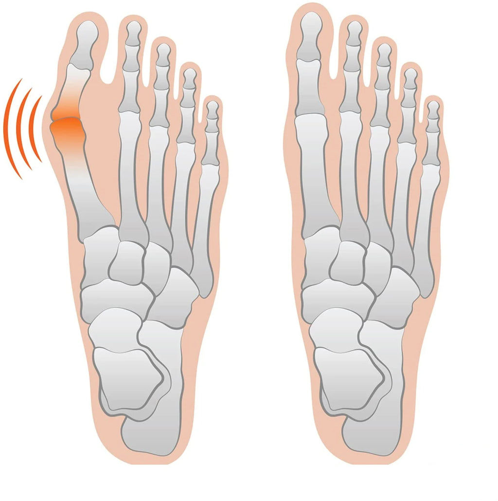 Bunion Corrector for Women & Men-Bunion Pads Relief Orthopedic Sock Cushion Sleeve Splint Gel Protector Support Brace w/Non-Slip