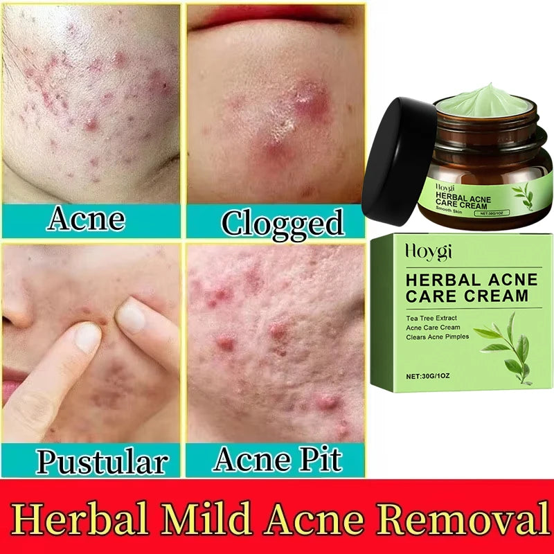 Natural Herbs Acid Acne Cream Shrink Pores Blackheads Scars Acne Marks Blemishes Oil Control Whitening Korean Skin Care Products