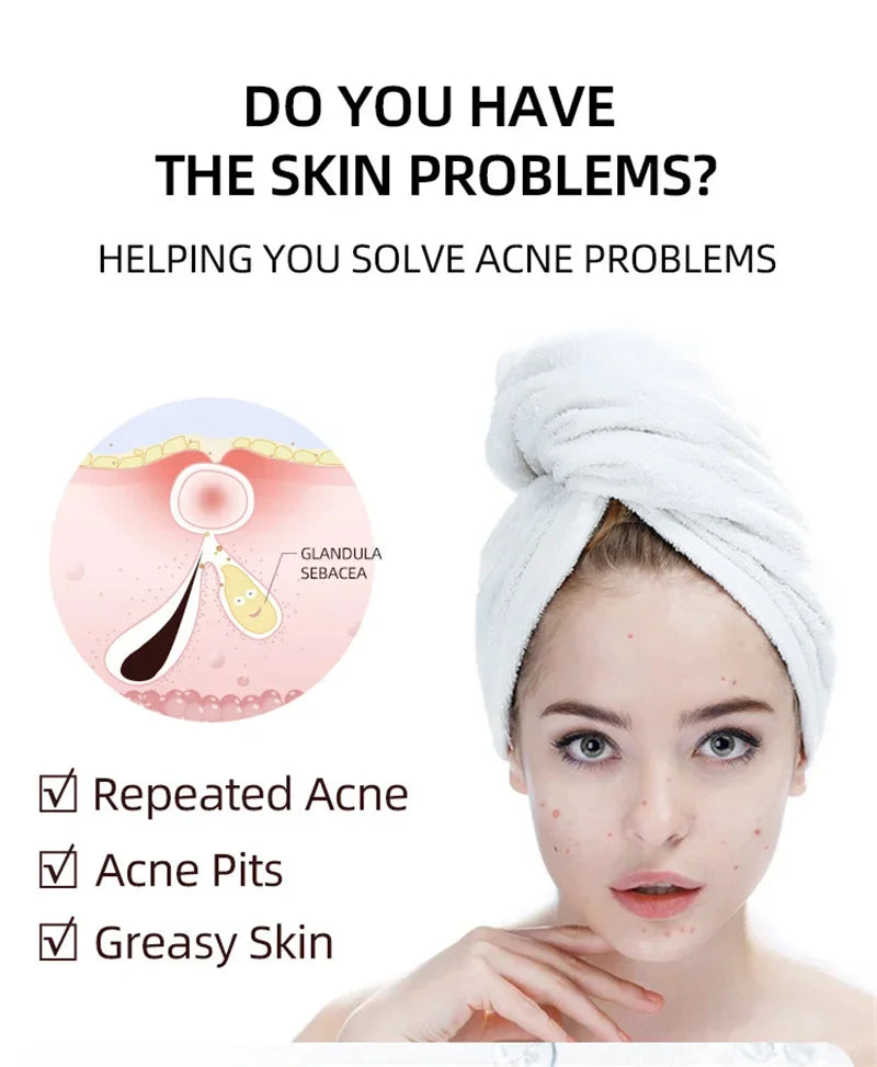 Acne Cream For Face Pimples Remover Treatment Shrink Pores Oil Control Lighten Acne Marks Whitening Smoothing Facial Skin Care