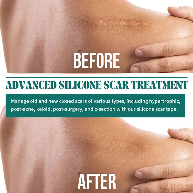 New 1 Roll Silicone Scar Sheets Gel Scar Patch 4cmX150cm Self-Adhesive Scar Cover Tape Reusable And Effective Skin Care Strips