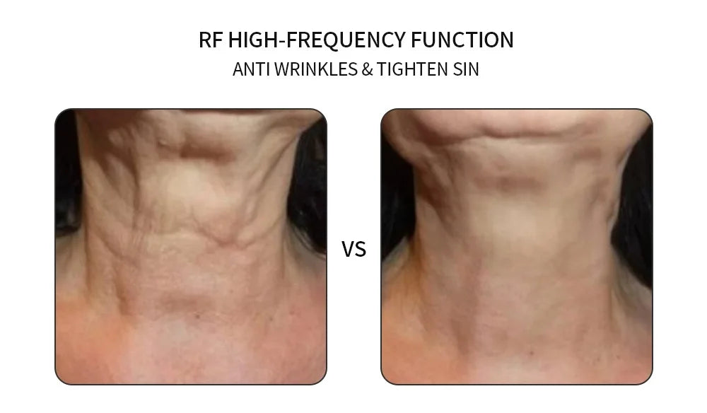 5-IN-1 RF EMS Electroporation Radio Frequency LED Photon Beauty Device Skin Lifting Tighten Anti-Wrinkle Skin Care Face Massager