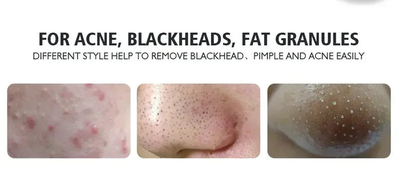 4PCS Acne Blackhead Comedone Black Spot Pimple Blemish Remover Skin Care Women Beauty Acne Treatment Pore Cleanser Needle Hook