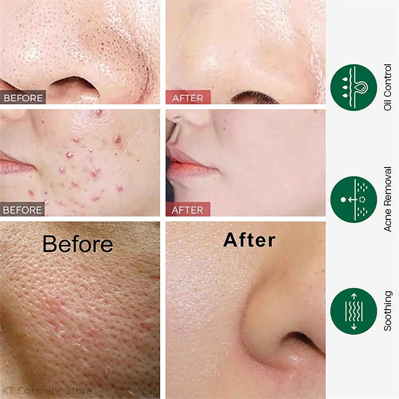 LAIKOU Tea Tree Serum 17ml Anti-Acne Cream 20g Cleanser 50g Plant Extract Refreshing Hydrating Moisturizing Skin Care Set Beauty