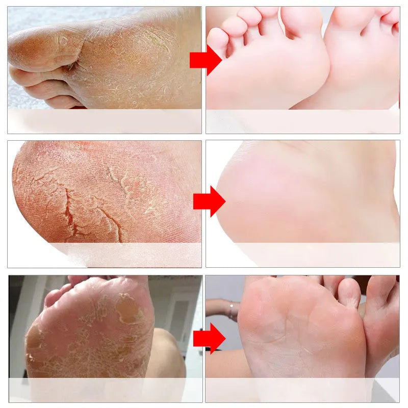 1-10Pcs Exfoliating Foot Mask Foot Spa Pedicure Socks Removing Dead Skin Whitening Heels Peeling Anti Cracked Foot Skin Care