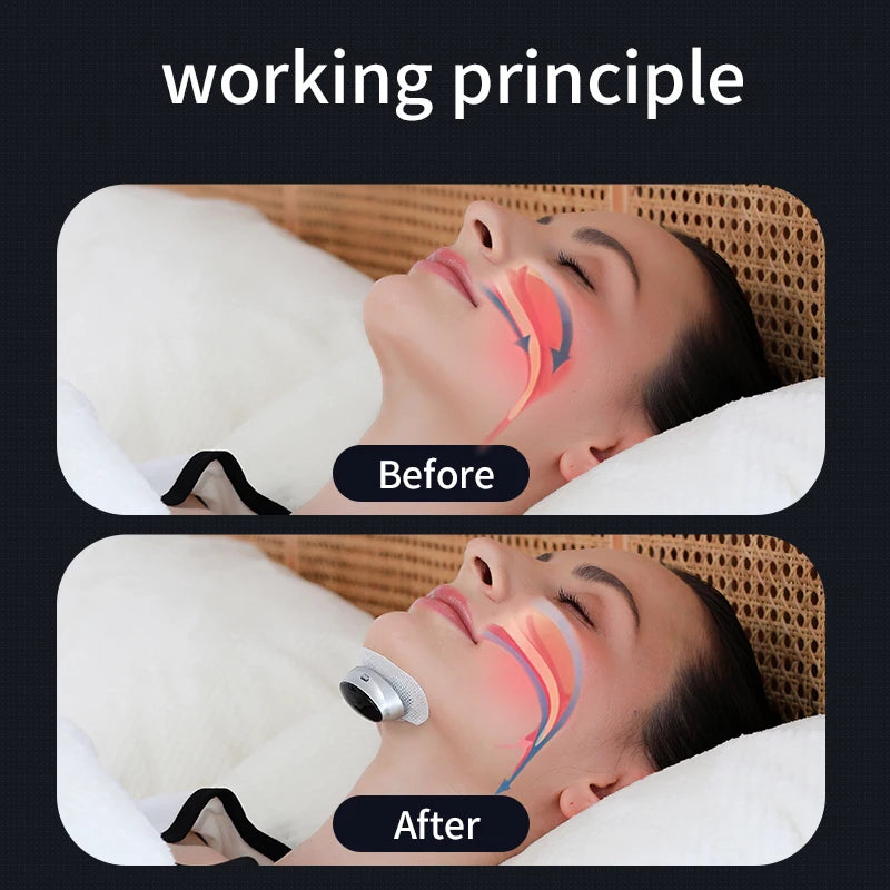 Anti-Snore Device with Dual-Pulse Stimulation - Sleep Apnea Relief