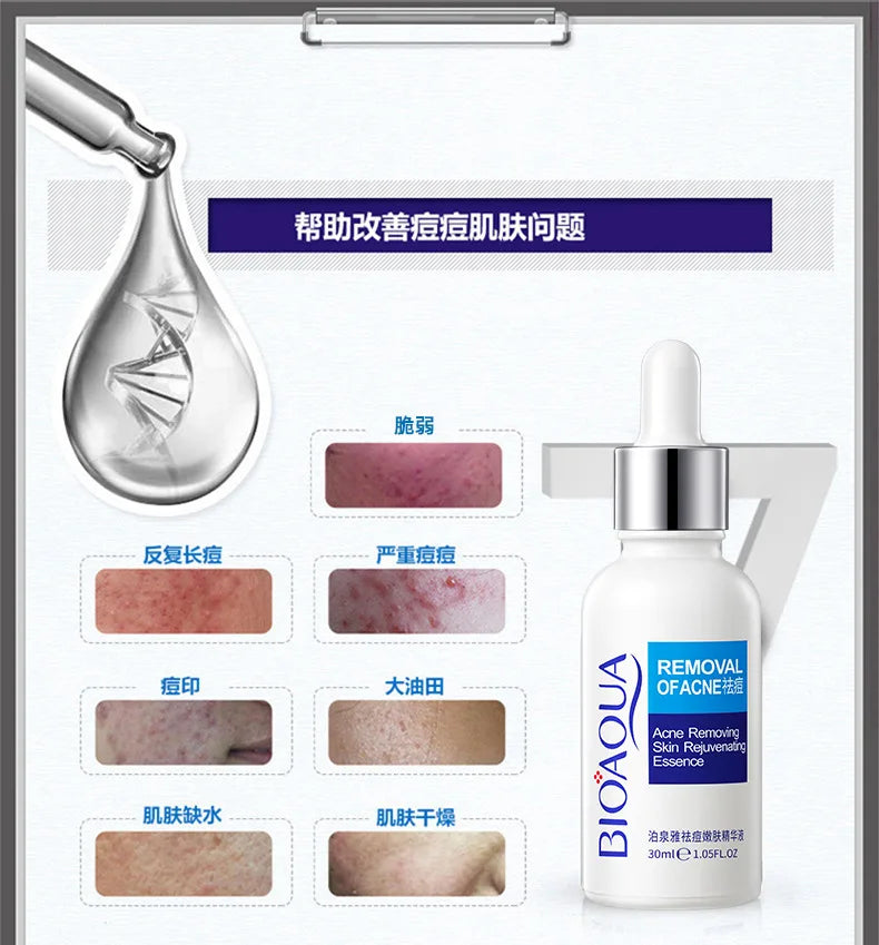 Treatment Cream Face Acne Remover Repair Gel Oil Control Serum Shrink Pores Whitening Facial mask Skin Care Korean Cosmetic