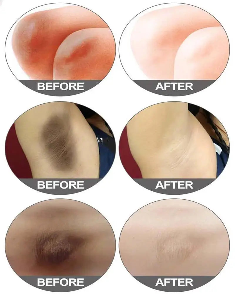 Whitening Cream For Dark Skin Underarm Bleaching Armpit Lightening And Intimate Area Woman Moisturizer Korean Skin Care Products