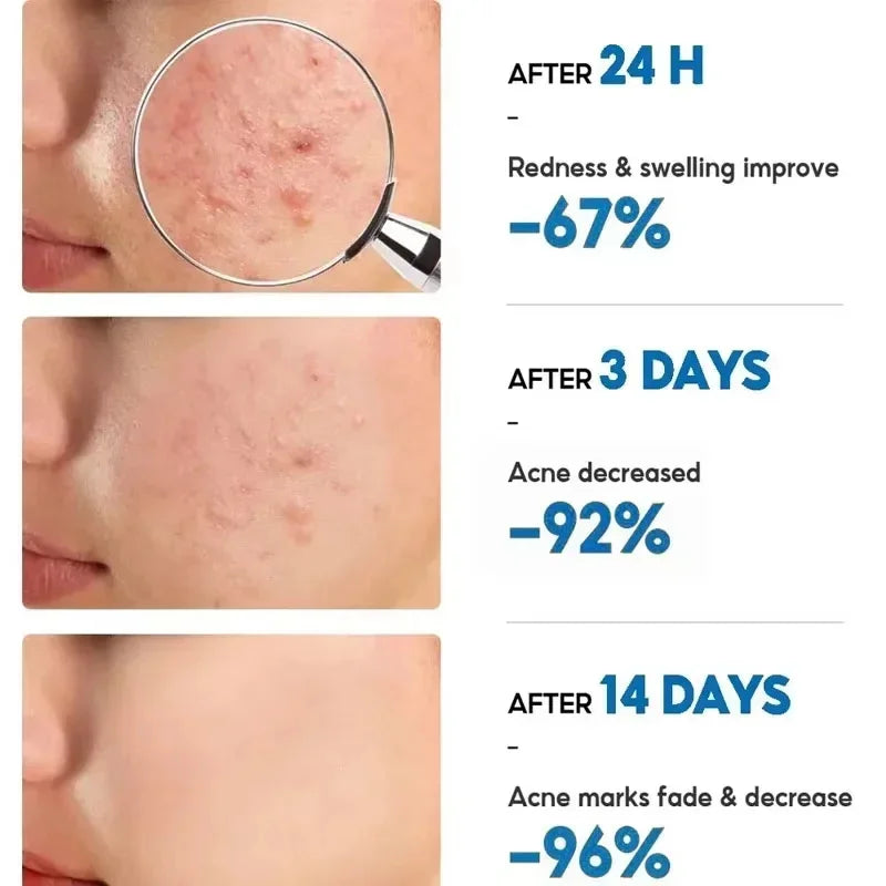 Effective Acne Removal Cream Anti-Acne Repair Redness Pimple Spots Gel Deep Cleaning Pore Oil Control Moisturizing Skin Care 30g