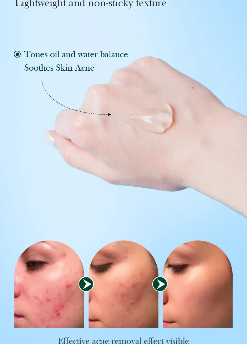 Tea Tree Acne Removing Cream Facial skincare Oil Control Face Gel Creams Hydrating Moisturizing Facial Cream Skin Care Set