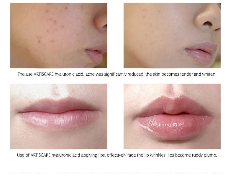 ARTISCARE Hyaluronic Acid Face Serum 5pcs for Moisturizing and  Brighten Long-Lasting Hydrating Skin Care Essence