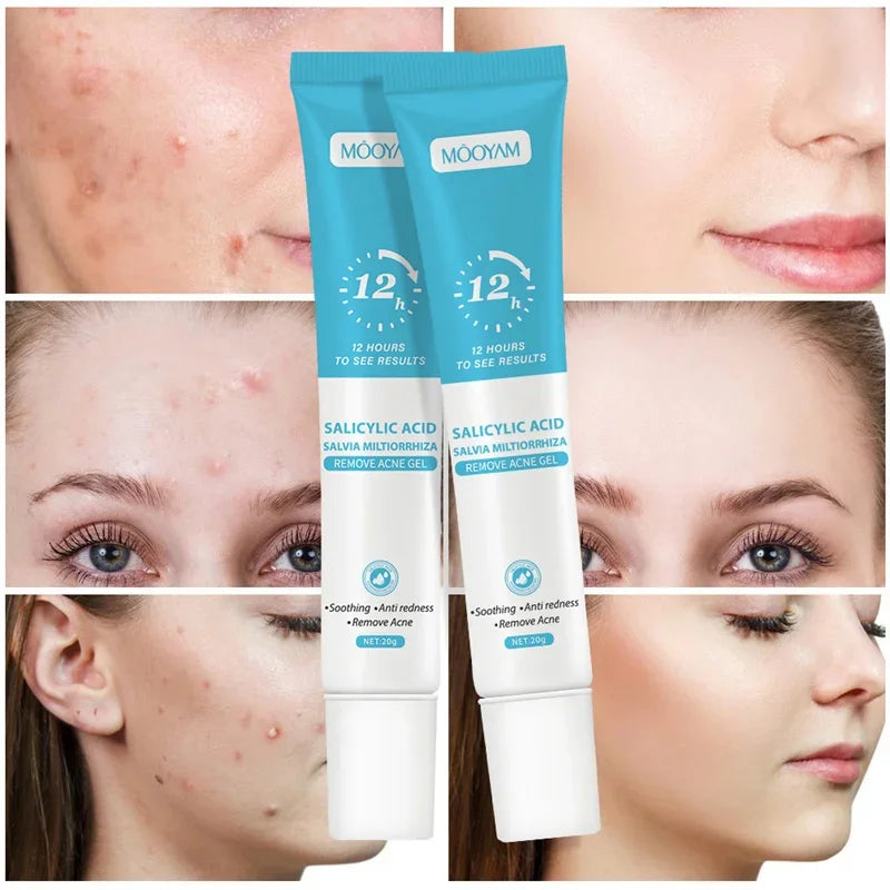 Acne Cream For Face Pimples Remover Treatment Shrink Pores Oil Control Lighten Acne Marks Whitening Smoothing Facial Skin Care