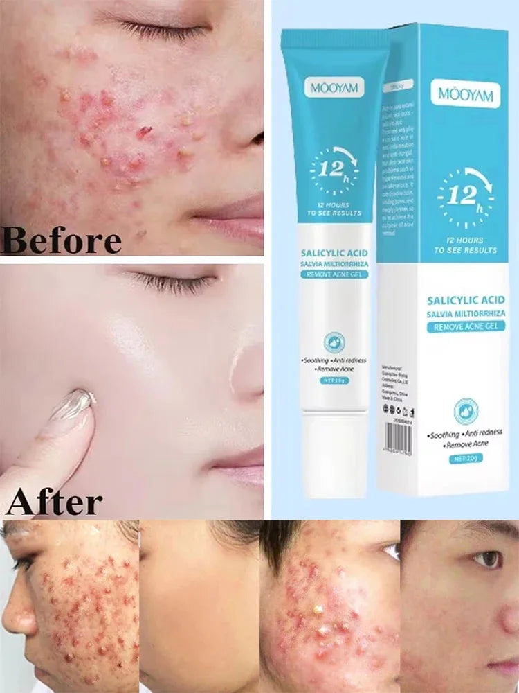 Acne Cream For Face Pimples Remover Treatment Shrink Pores Oil Control Lighten Acne Marks Whitening Smoothing Facial Skin Care