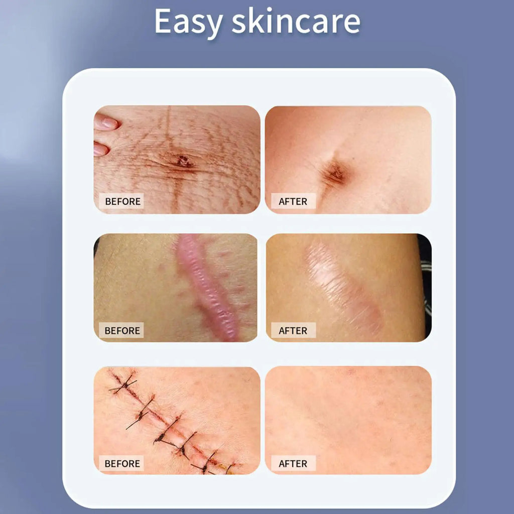 1 Roll Invisible Silicone Scar Sheets Self-Adhesive Scar Cover Tape Reusable and Effective Skin Care Strips