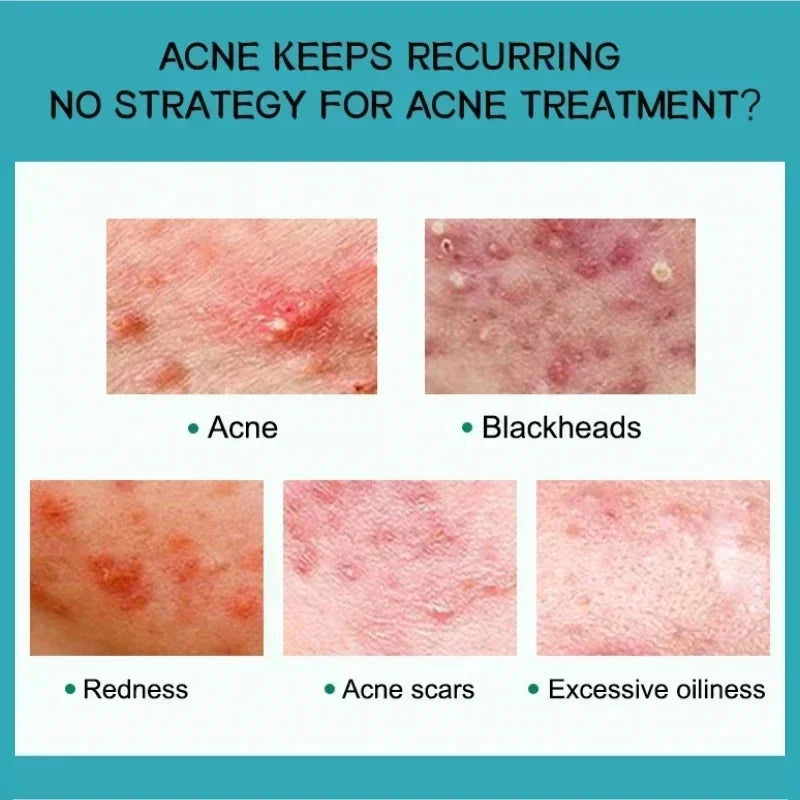Effective Acne Removal Cream Anti-Acne Repair Redness Pimple Spots Gel Deep Cleaning Pore Oil Control Moisturizing Skin Care 30g