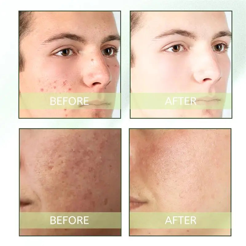 Natural Herbs Acid Acne Cream Shrink Pores Blackheads Scars Acne Marks Blemishes Oil Control Whitening Korean Skin Care Products