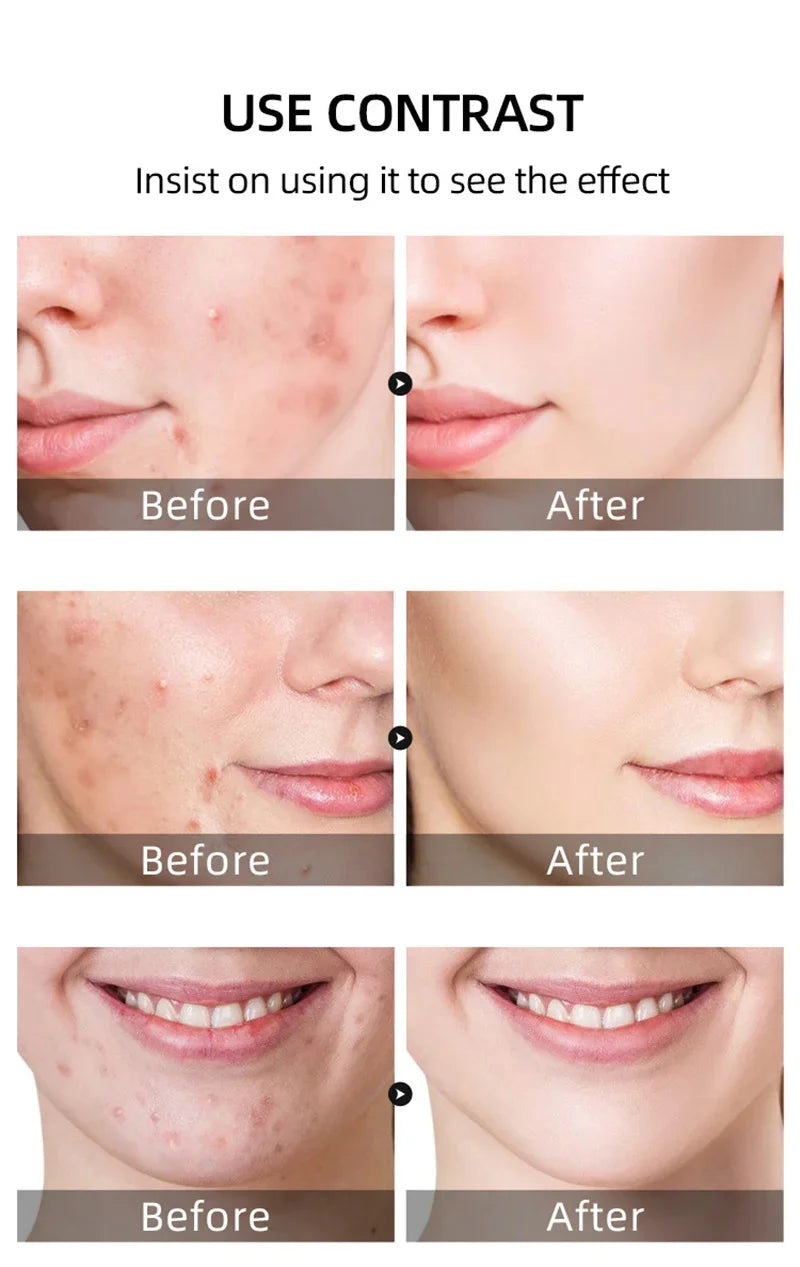 Acne Cream For Face Pimples Remover Treatment Shrink Pores Oil Control Lighten Acne Marks Whitening Smoothing Facial Skin Care