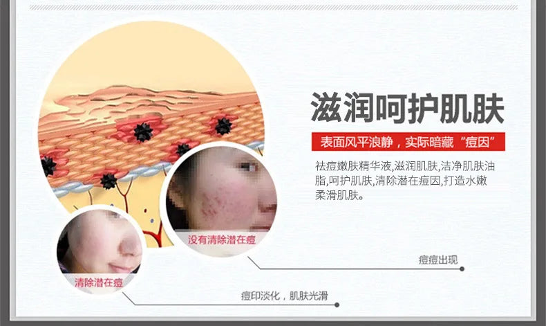 Treatment Cream Face Acne Remover Repair Gel Oil Control Serum Shrink Pores Whitening Facial mask Skin Care Korean Cosmetic
