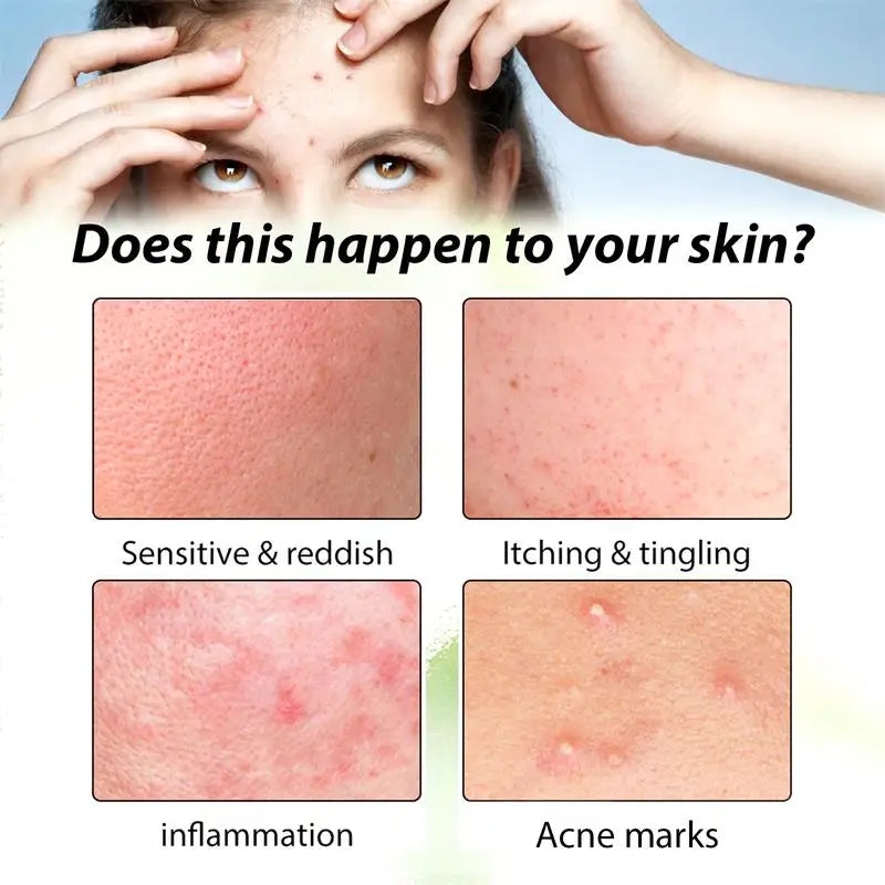 Natural Herbs Acid Acne Cream Shrink Pores Blackheads Scars Acne Marks Blemishes Oil Control Whitening Korean Skin Care Products