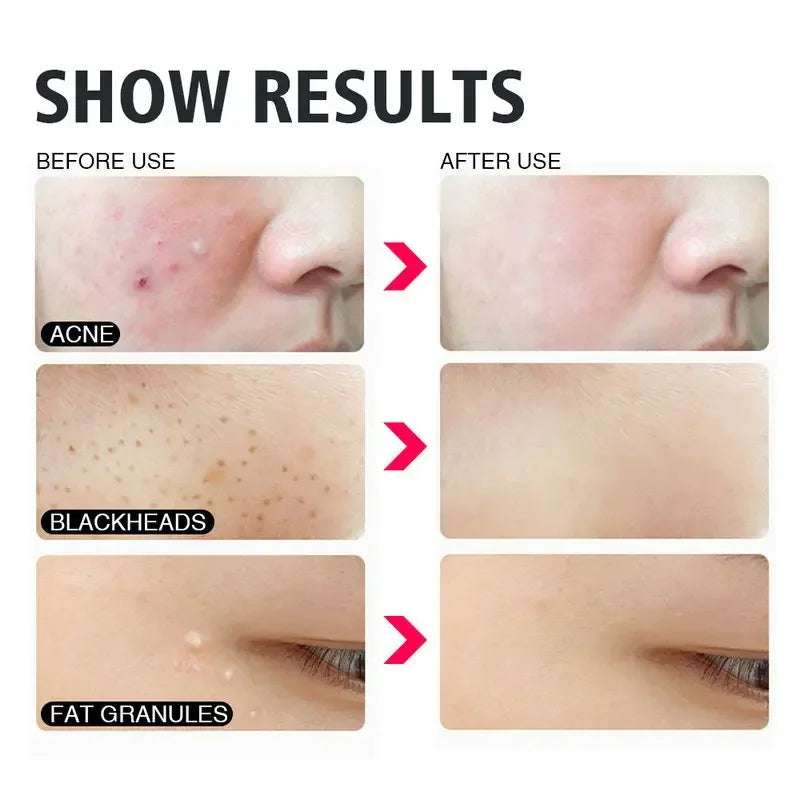 4PCS Acne Blackhead Comedone Black Spot Pimple Blemish Remover Skin Care Women Beauty Acne Treatment Pore Cleanser Needle Hook