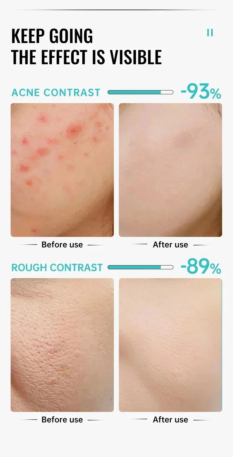Effective Acne Removal Cream Anti-Acne Repair Redness Pimple Spots Gel Deep Cleaning Pore Oil Control Moisturizing Skin Care 30g