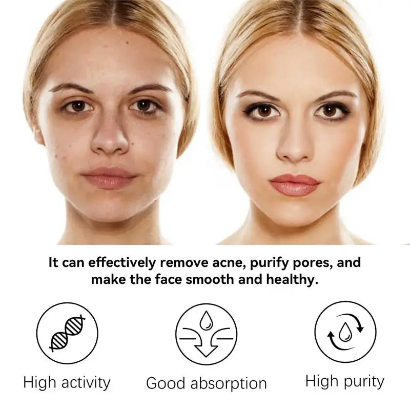 Natural Herbs Acid Acne Cream Shrink Pores Blackheads Scars Acne Marks Blemishes Oil Control Whitening Korean Skin Care Products