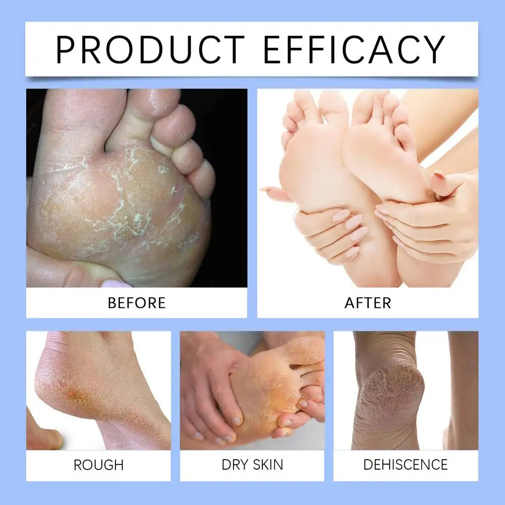 Urea Care Foot Cream Heel Repair Moisturizing Soft Relieve Drying Cracked Remove Calluses Dead Skin Removal Hand Foot Skin Care