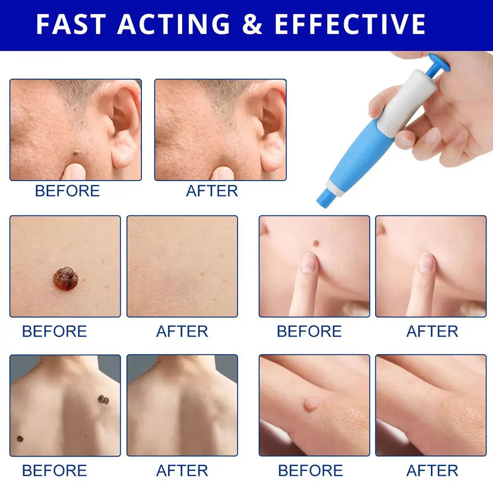 Skin Tag Removal Trade Double Head Wart Remover Pen Kit Home Use Face Skin Care Tool