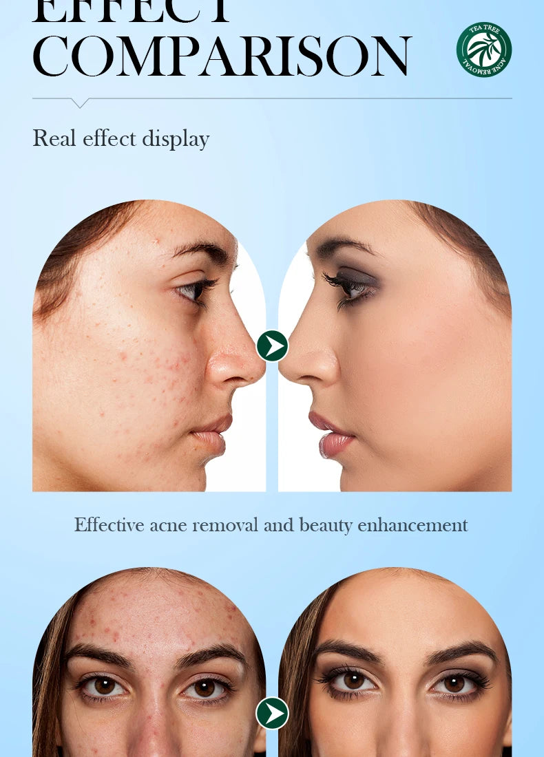 Tea Tree Acne Removing Cream Facial skincare Oil Control Face Gel Creams Hydrating Moisturizing Facial Cream Skin Care Set