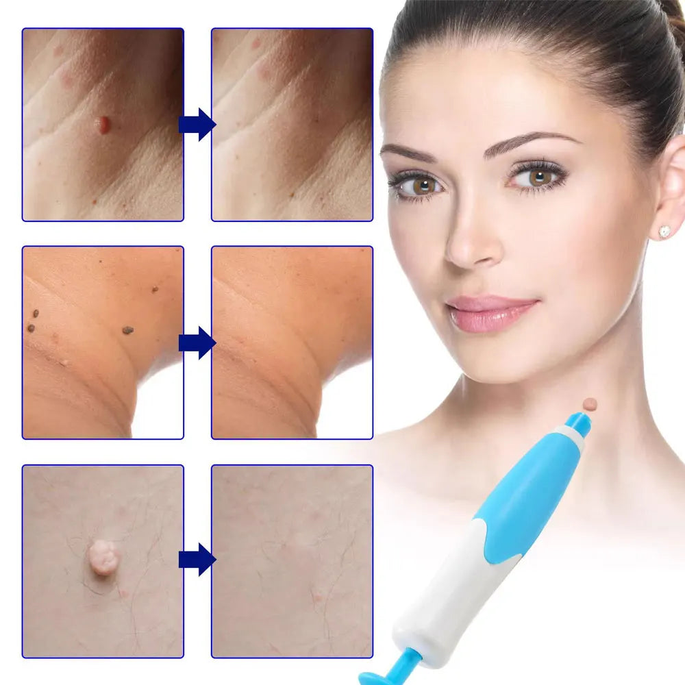 Skin Tag Removal Trade Double Head Wart Remover Pen Kit Home Use Face Skin Care Tool