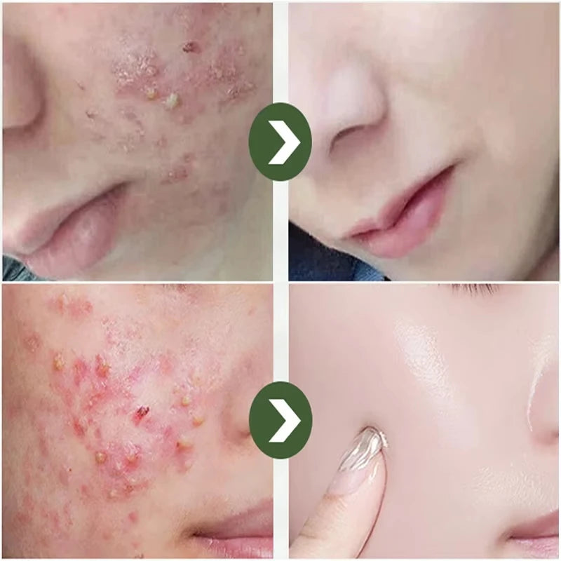 Natural Herbs Acid Acne Cream Shrink Pores Blackheads Scars Acne Marks Blemishes Oil Control Whitening Korean Skin Care Products