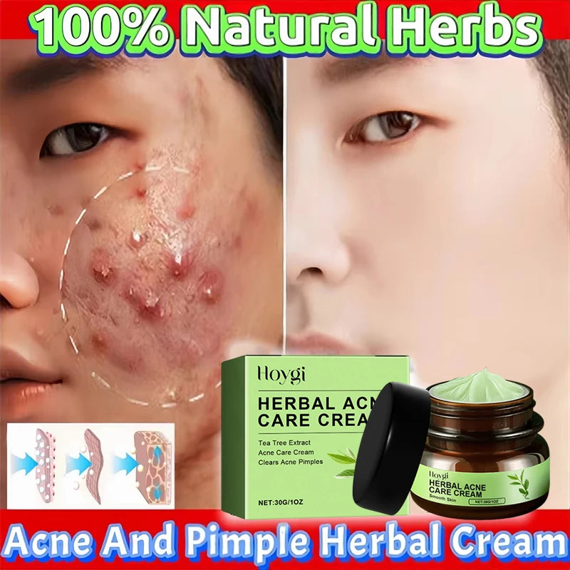 Natural Herbs Acid Acne Cream Shrink Pores Blackheads Scars Acne Marks Blemishes Oil Control Whitening Korean Skin Care Products