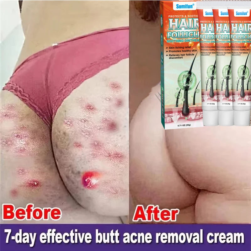 Body Acne Removal Cream Treatment Face Butt Back Acne Marks Smooth Repair Chicken Skin Cream Moisturizing Whitening Skin Care
