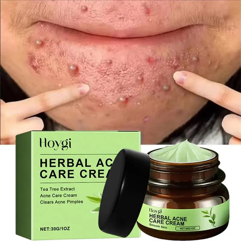 Natural Herbs Acid Acne Cream Shrink Pores Blackheads Scars Acne Marks Blemishes Oil Control Whitening Korean Skin Care Products