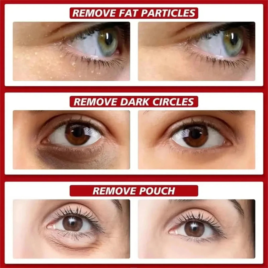 Fat Granules Removal Eyestick Anti-Puffiness Firming Cream Anti Inflammatory Fade Fine Line Repair Skin Barrier Korean Skin Care