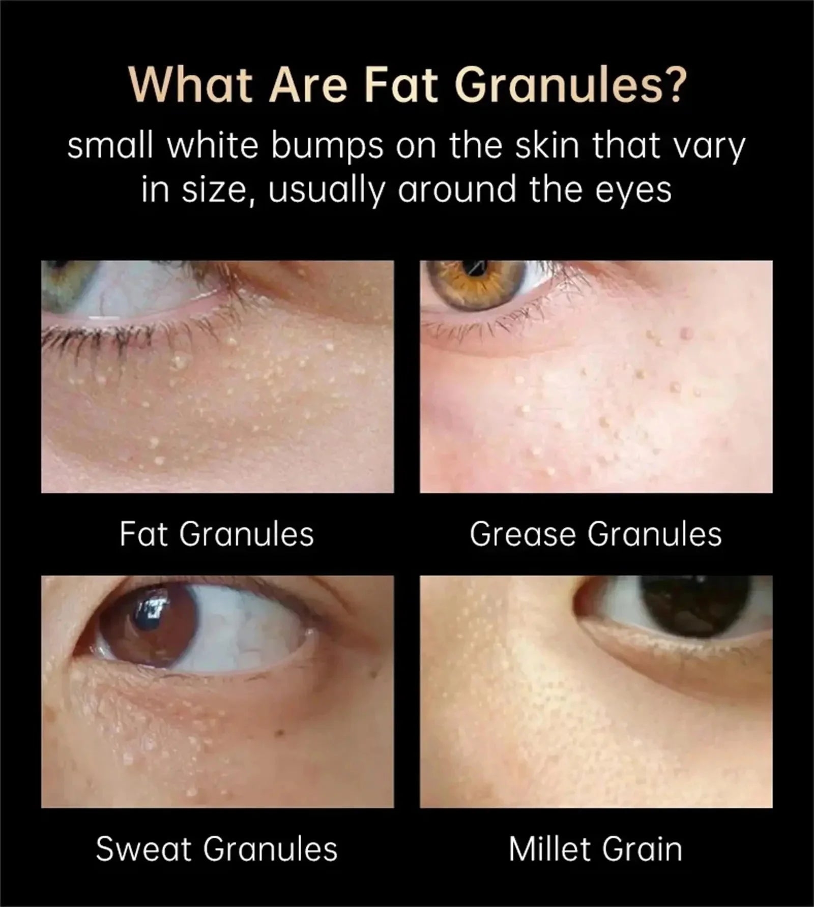 Fat Granules Removal Eyestick Anti-Puffiness Firming Cream Anti Inflammatory Fade Fine Line Repair Skin Barrier Korean Skin Care