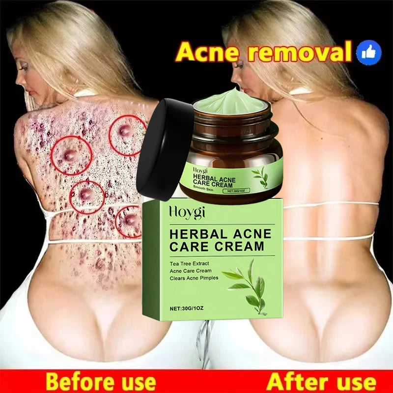 Natural Herbs Acid Acne Cream Shrink Pores Blackheads Scars Acne Marks Blemishes Oil Control Whitening Korean Skin Care Products