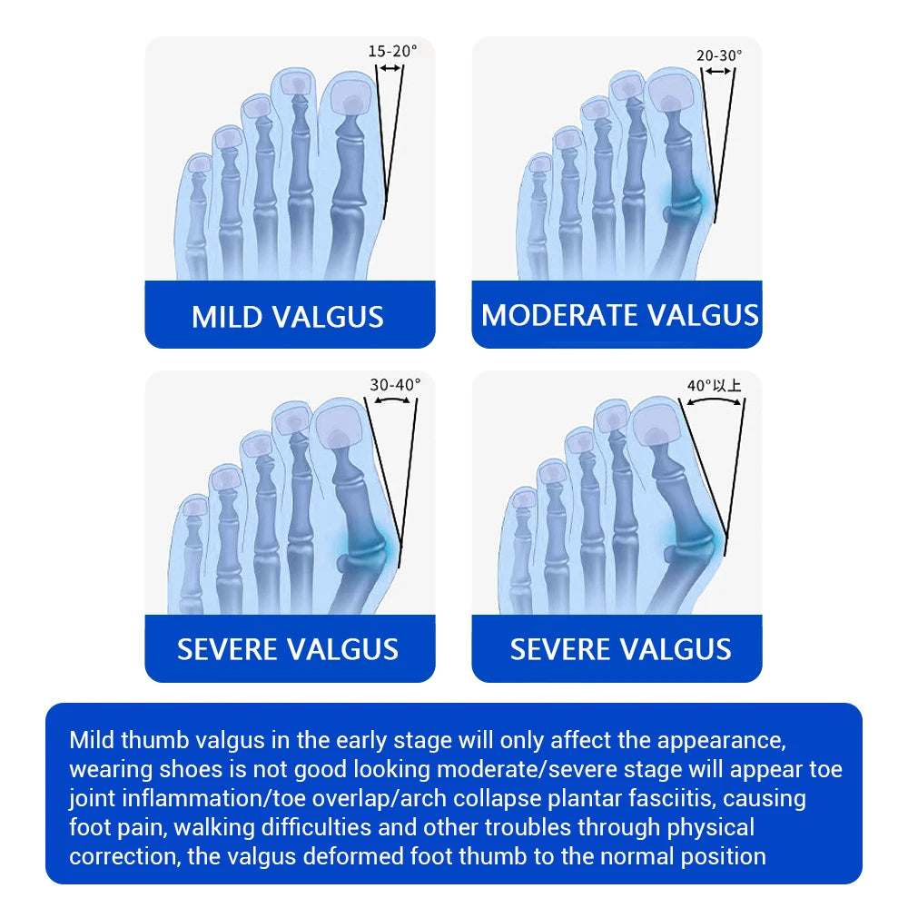 Bunion Splint Big Toe Straightener Hallux Valgus Correction Orthotics Foot Bone Thumb Adjuster Correction Bunions Corrector