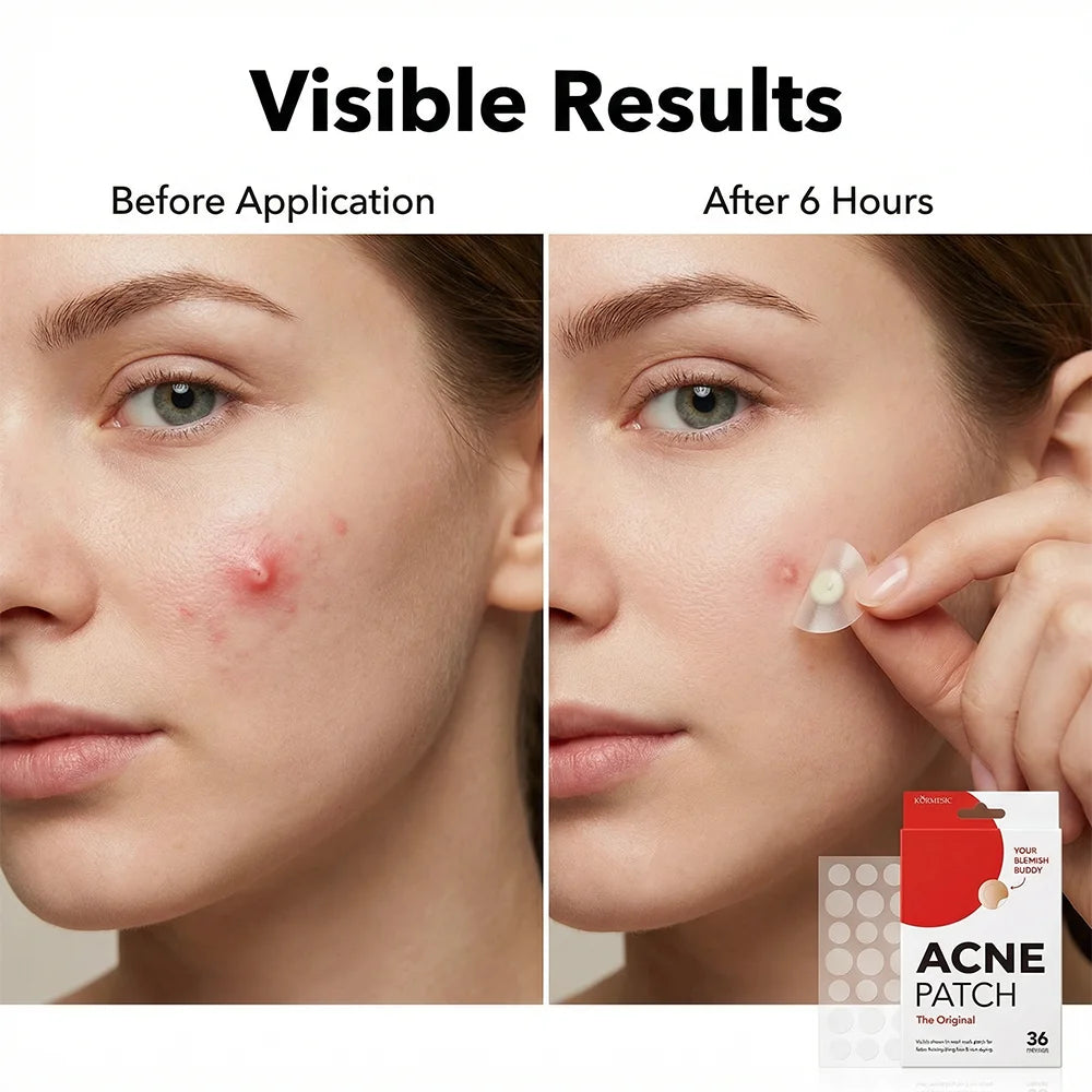 36pcs Hydrocolloid Acne Patches Invisible Pimple Patches for Face Absorb Pus Oil Reduce Redness Zit Stickers All Day Invisible