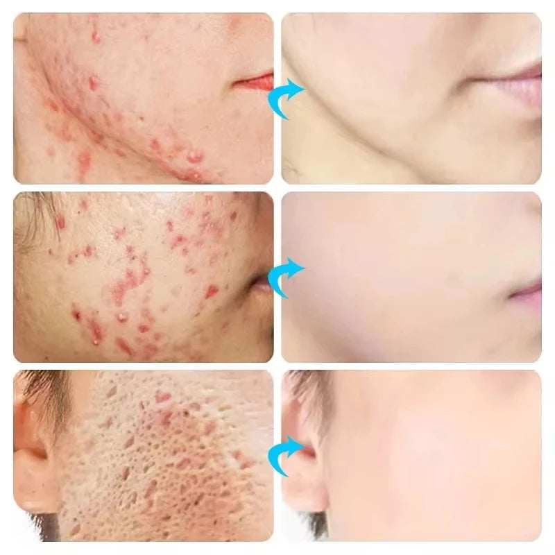 Body Acne Removal Cream Treatment Face Butt Back Acne Marks Smooth Repair Chicken Skin Cream Moisturizing Whitening Skin Care