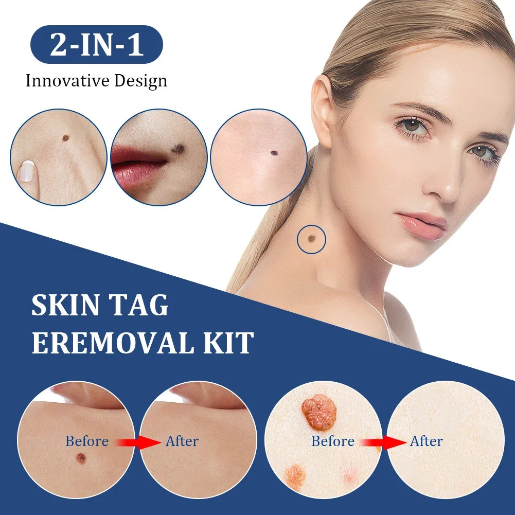 2 In 1 Auto Skin Tag Removal Kit Painless Mole Wart Remover Equipment Micro 1-9mm Treatment Tool Easy To Clean Skin Care Tool