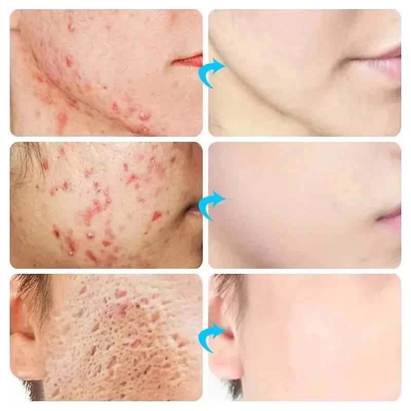 Effective Acne Removal Cream Anti-Acne Repair Redness Pimple Spots Gel Deep Cleaning Pore Oil Control Moisturizing Skin Care 30g