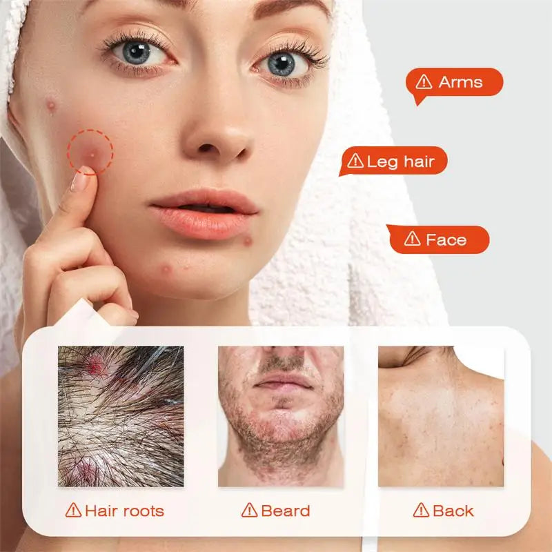 Body Acne Removal Cream Treatment Face Butt Back Acne Marks Smooth Repair Chicken Skin Cream Moisturizing Whitening Skin Care