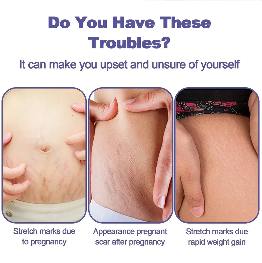 Stretch Mark Vanishing Cream Remove Body Buttock Breast Marks Effective Repair Maternity Loose Firming Skin Care
