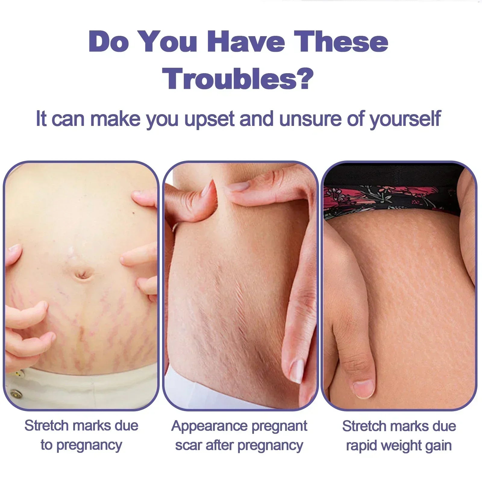 Stretch Mark Vanishing Cream Remove Body Buttock Breast Marks Effective Repair Maternity Loose Firming Skin Care